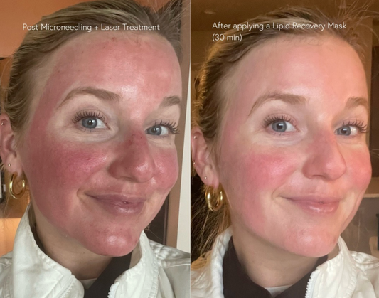 Lipid Recovery Mask