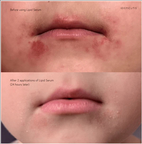 Lipid Serum